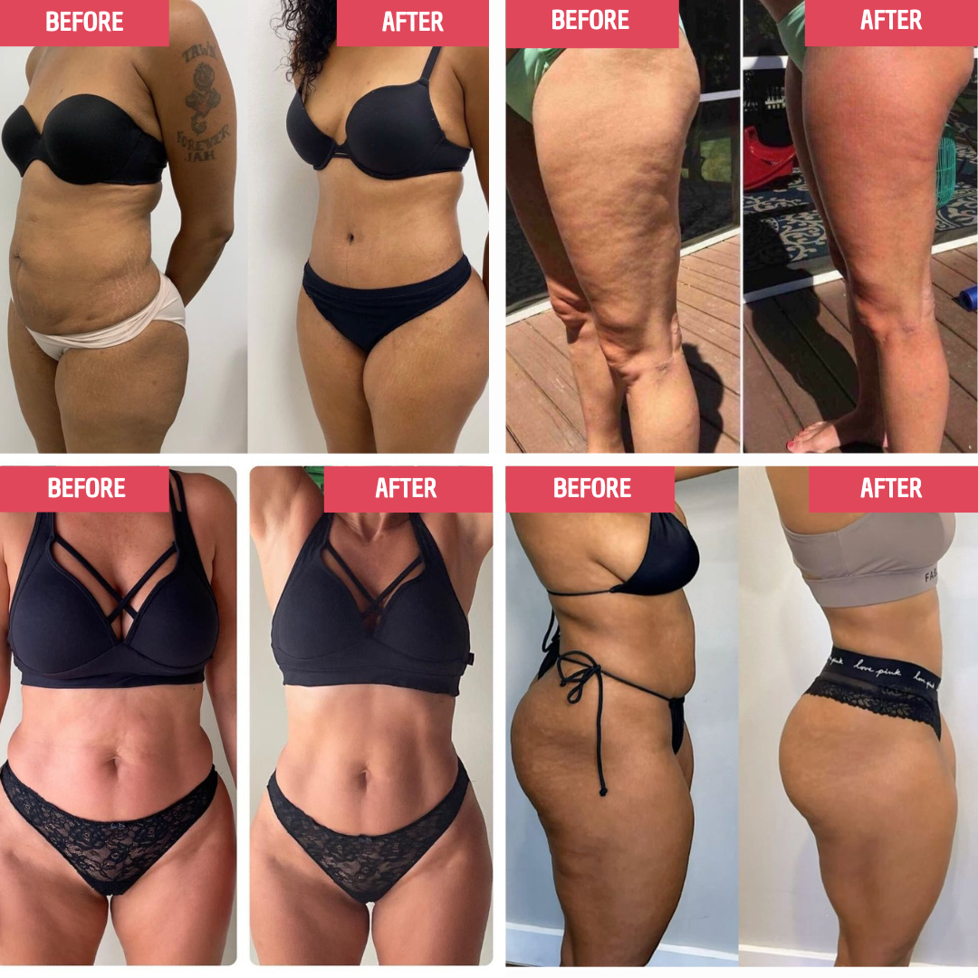 Anti-cellulite Vaccum massager